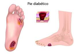 Pie Diab�tico